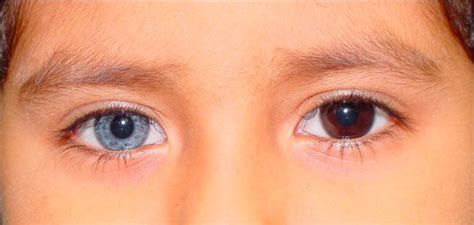 Heterochromia: Causes, Types, Risk Factors, and Treatment.